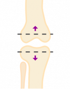 Resection
