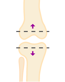 Resection-sm Resection