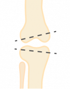 Varus-valgus