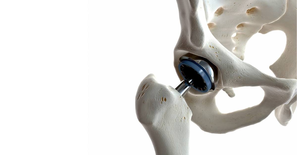 The Evolution Of Total Hip Replacement Intellijoint Surgical