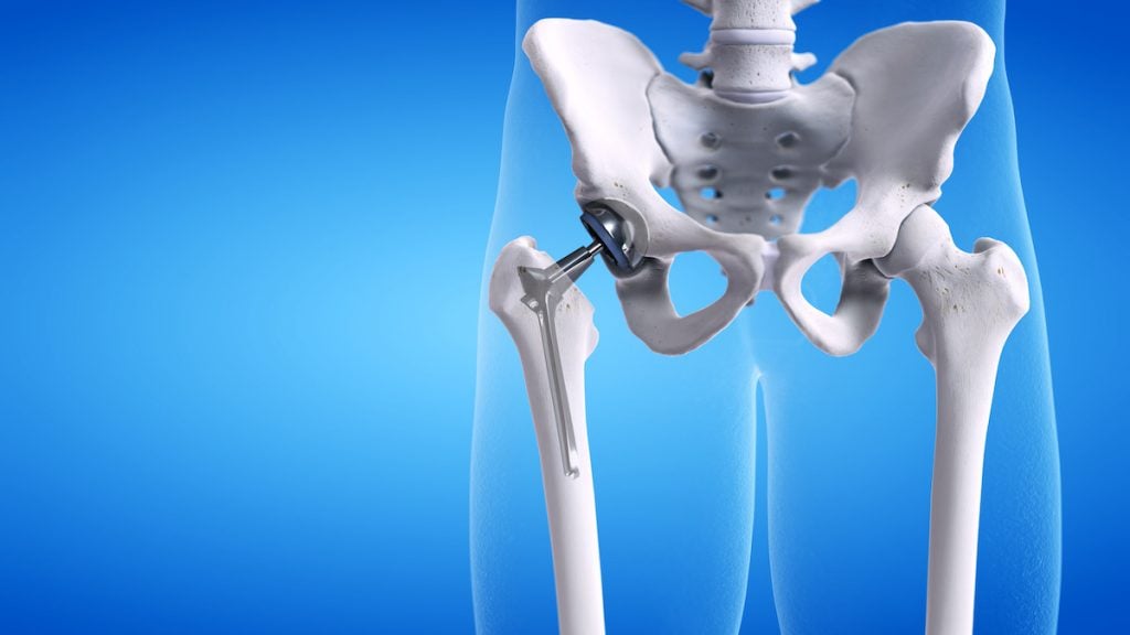 A 3D illustration showing prosthetic implants after a hip replacement surgery.