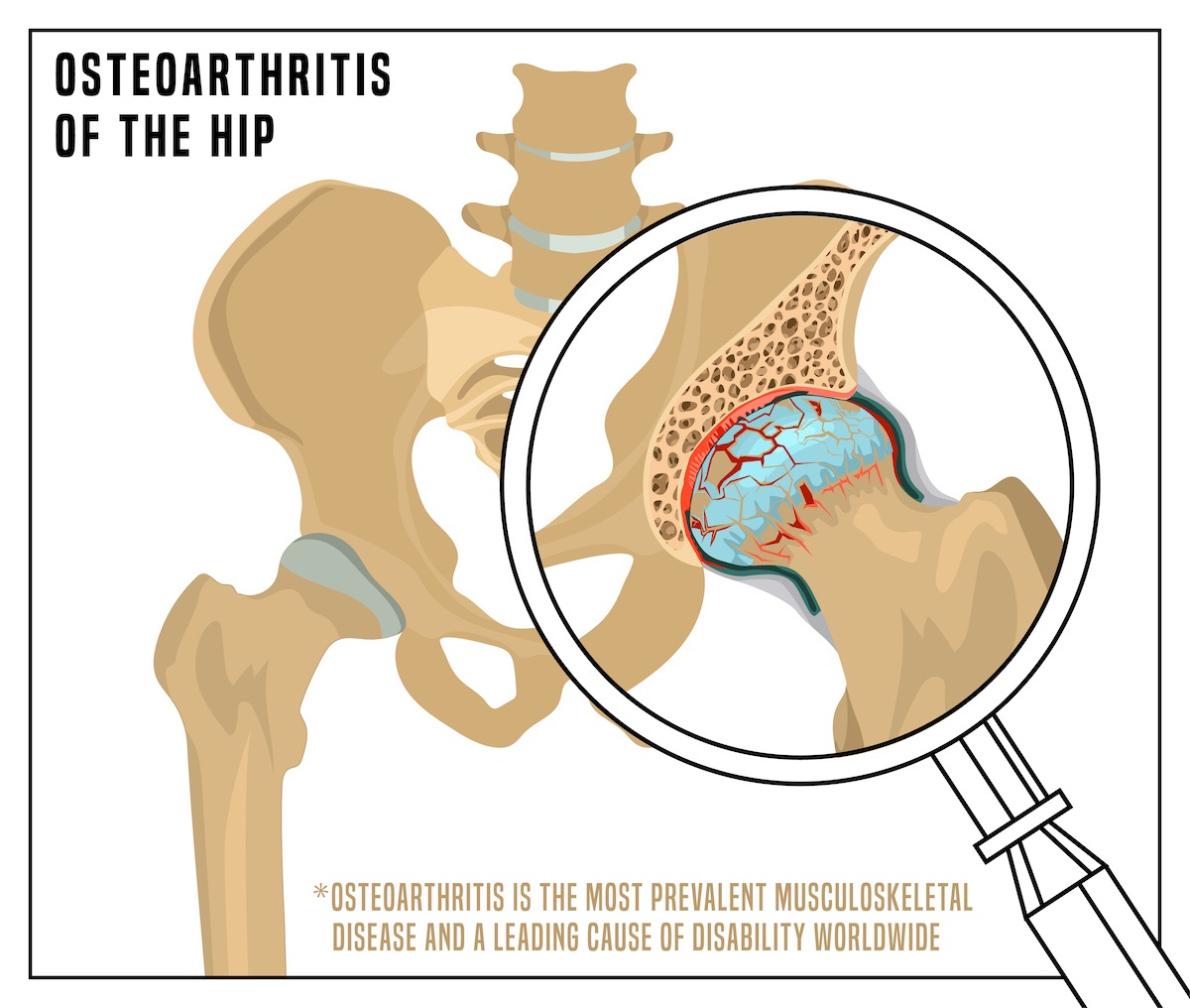 An illustration showing the worn cartilage caused byosteoarthritis of the hip.