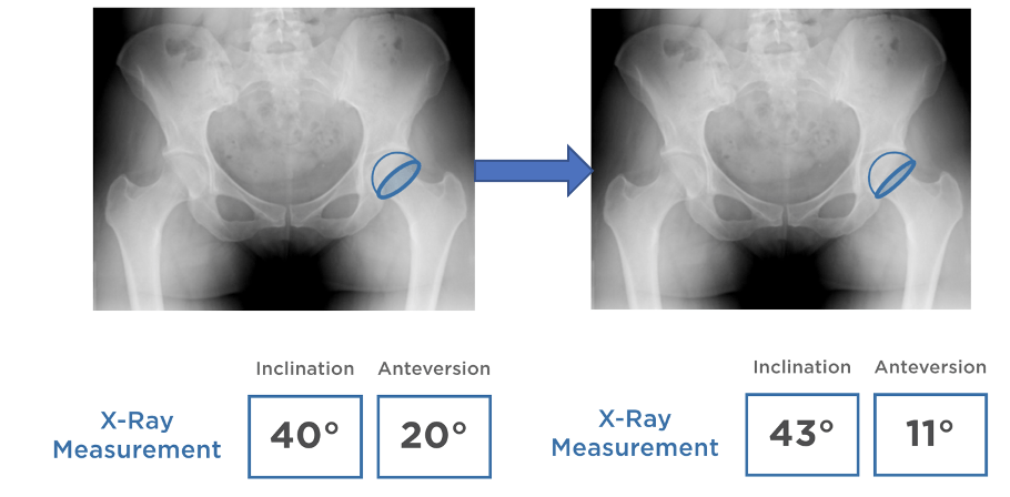 Xray pictures of hip replacement joints to show differences in inclination and anteversion.