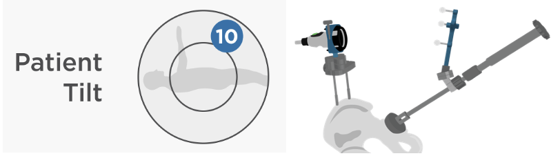 An illustration showing Intellijoint HIP being used to overcome patient tilt.