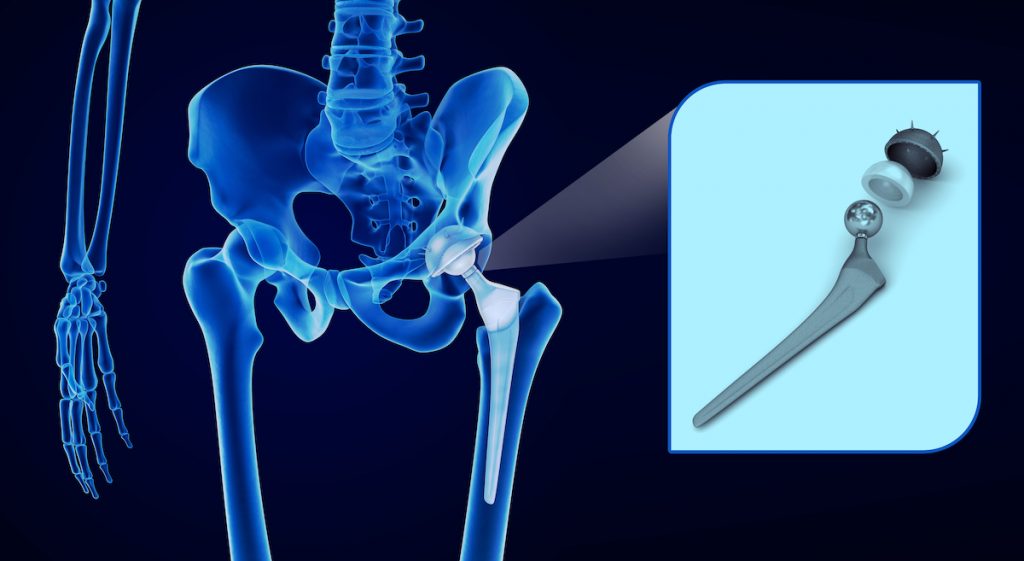 Xray image of hip replacement prosthetic parts