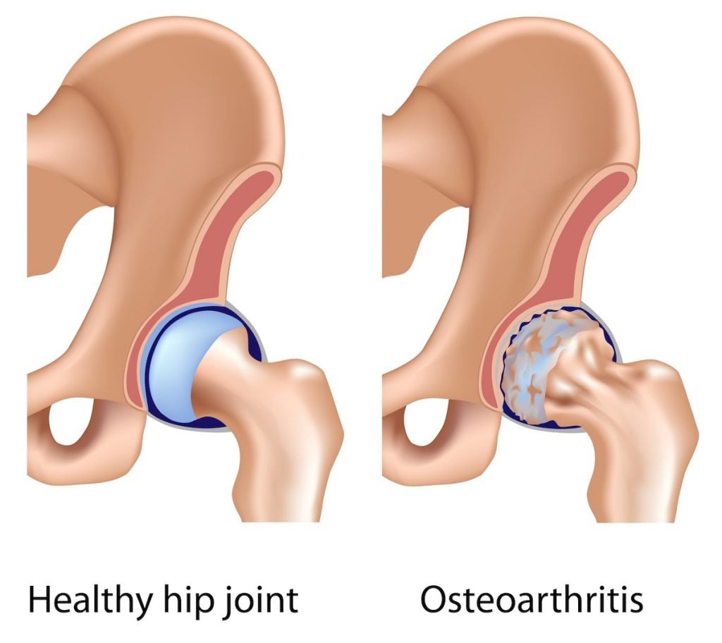 Osteoarthritis in the hip is a sign it's time for hip replacement.