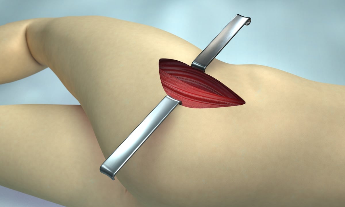 3D illustration showing the incision of a lateral surgical approach.