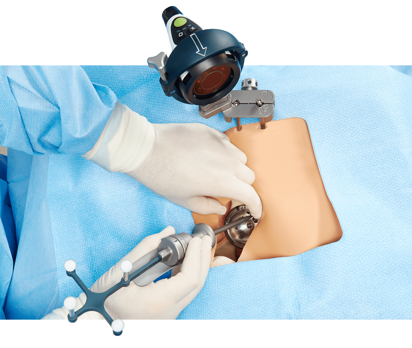 Intellijoing HIP Image - OpenPlatform Top view of surgeon performing THA with Intellijoint HIP navigation camera and tools