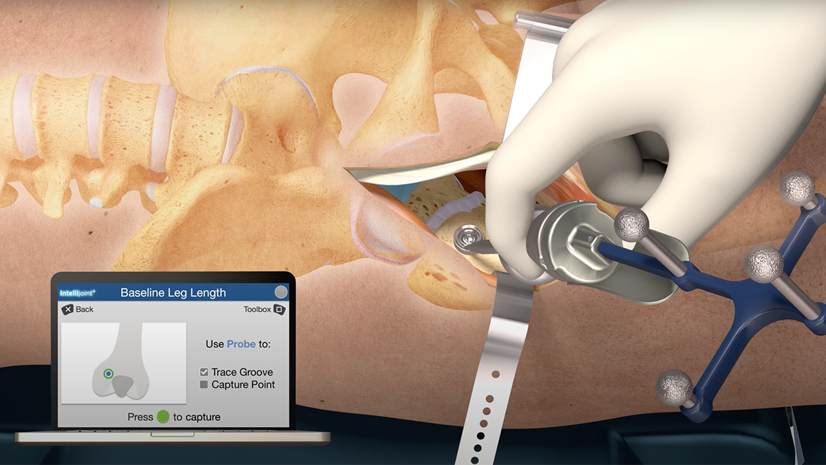 Video still of hip surgery showing how to find Baseline Leg Length