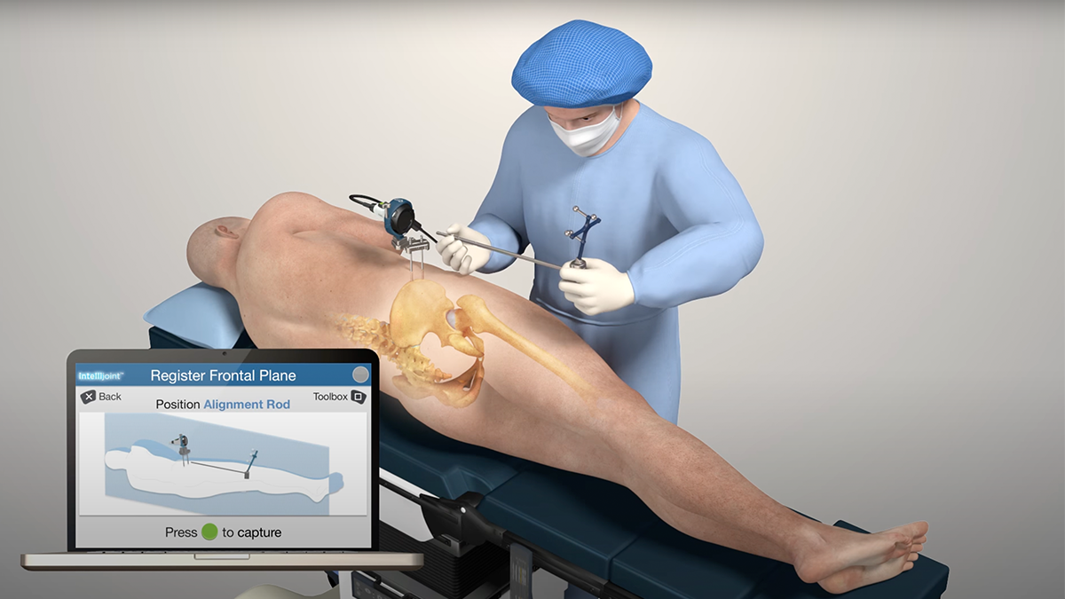 Surgeon registering frontal plane on patient in the lateral/posterior position