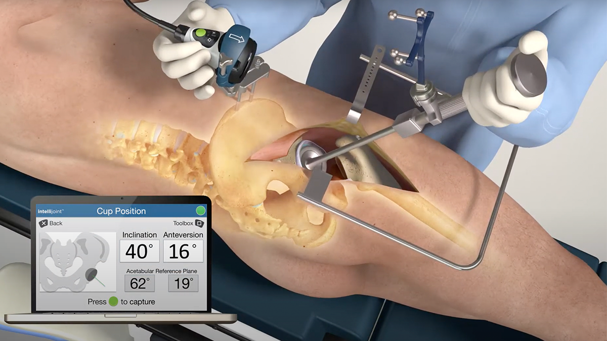 Surgeon registering cup position on patient in the lateral/posterior position