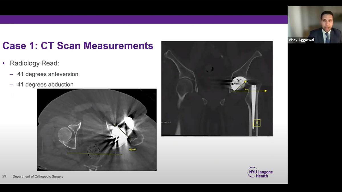 Dr.Vinay Aggarwal presenting a radiology read showing 2 CT Scan measurements