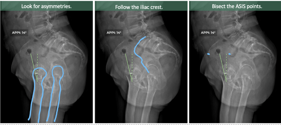 VIEW landmarking with x-rays