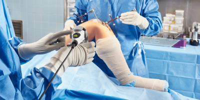 Surgeons performing knee replacement using computer-assisted surgery, Intellijoint KNEE